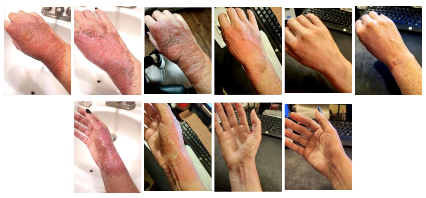 Ten photographs documenting a severe grease burn on a customer's hand healing across three weeks of Pink Relief use, November to December 2022.